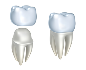Methuen, MA dental crowns