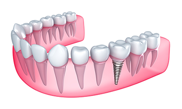 Methuen, MA dental implants